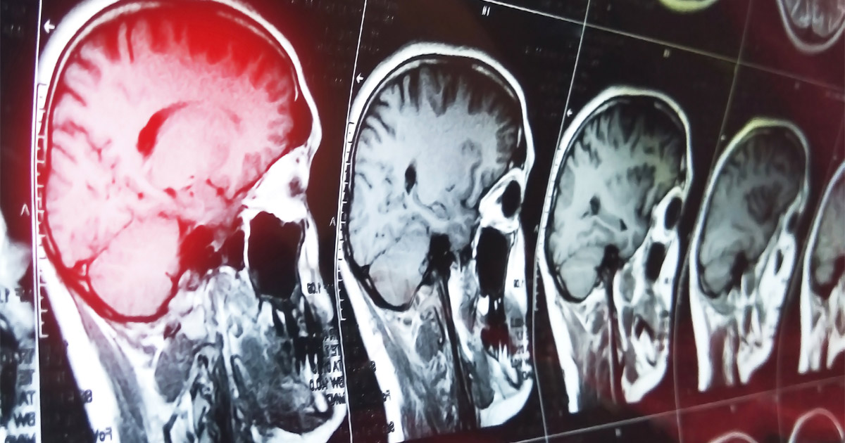 Domestic Violence and Brain Injuries